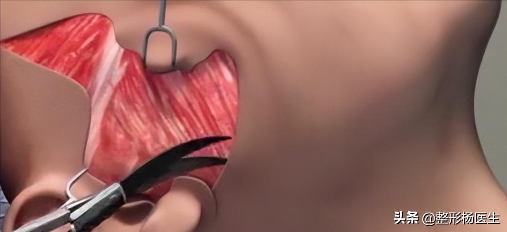 拉皮手术危险有真相,做拉皮手术后遗症