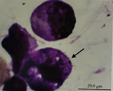 uu感染是什么意思,uu感染严重吗