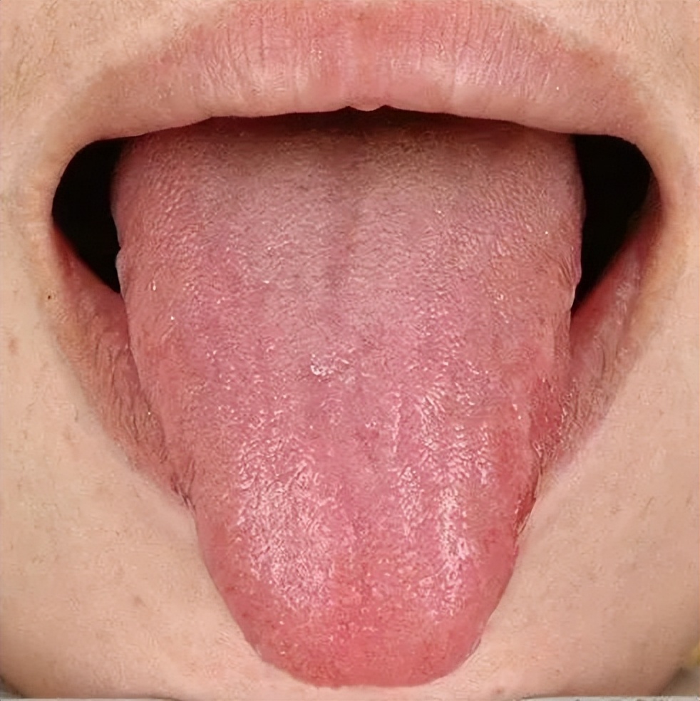 新冠后一直咳嗽有痰严重吗,我是新冠肺炎干咳无痰十几天了