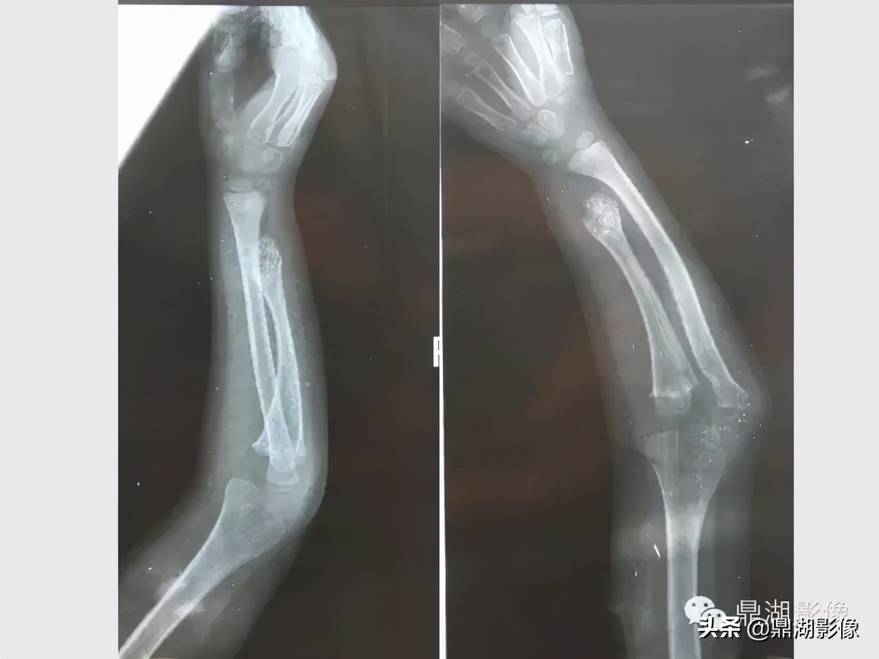 先天桡骨缺失畸形能治疗吗,先天性桡骨发育不良