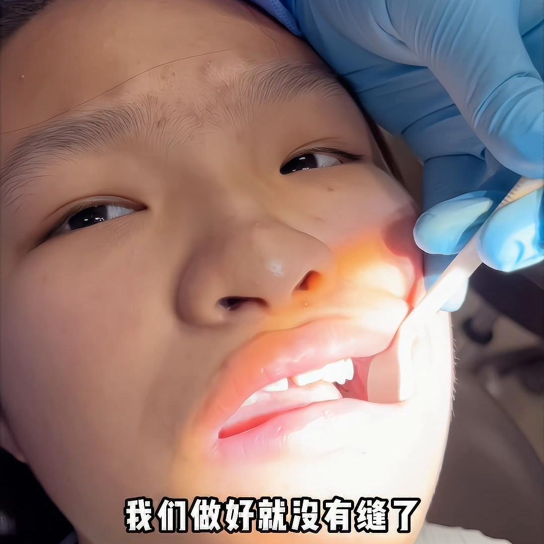 牙齿矫正龅牙拔牙全过程,矫正牙齿开颌拔牙的全部过程