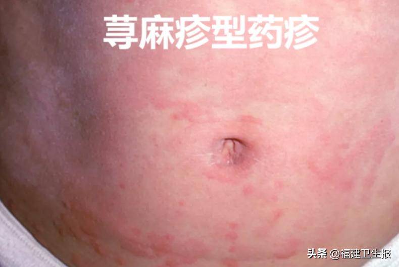 阳了后浑身痒、起疹子？医生提醒：分清类型再治疗