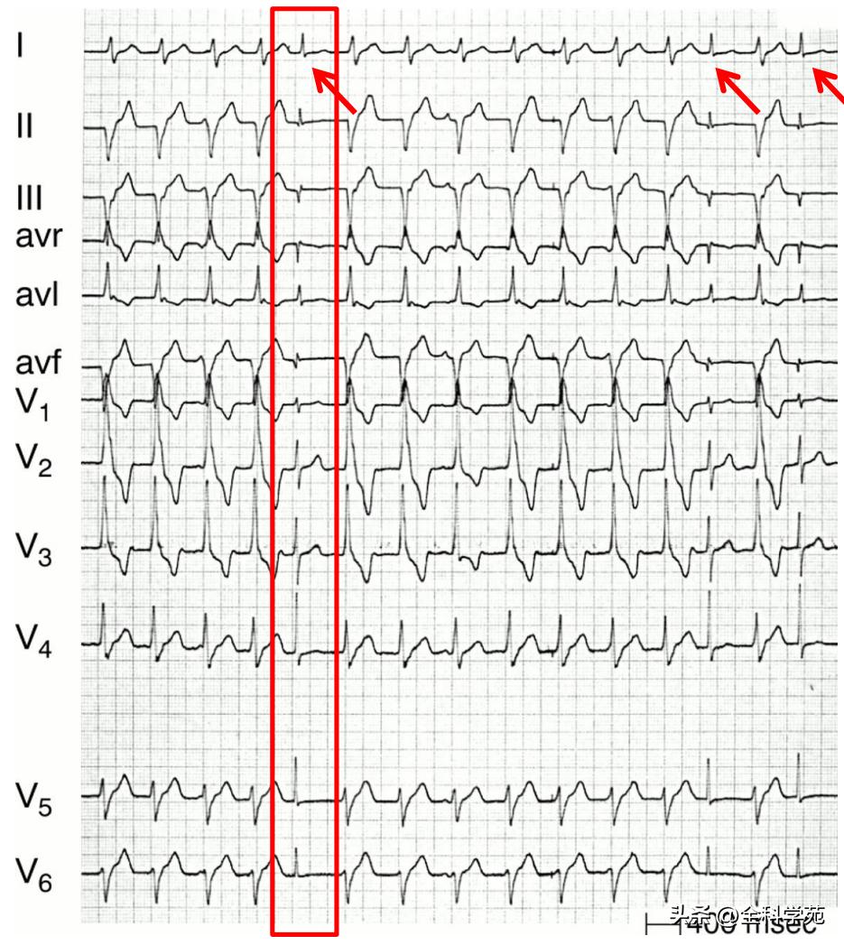 心电图上表现为宽qrs波,心电图中qrs是代表心动过速吗