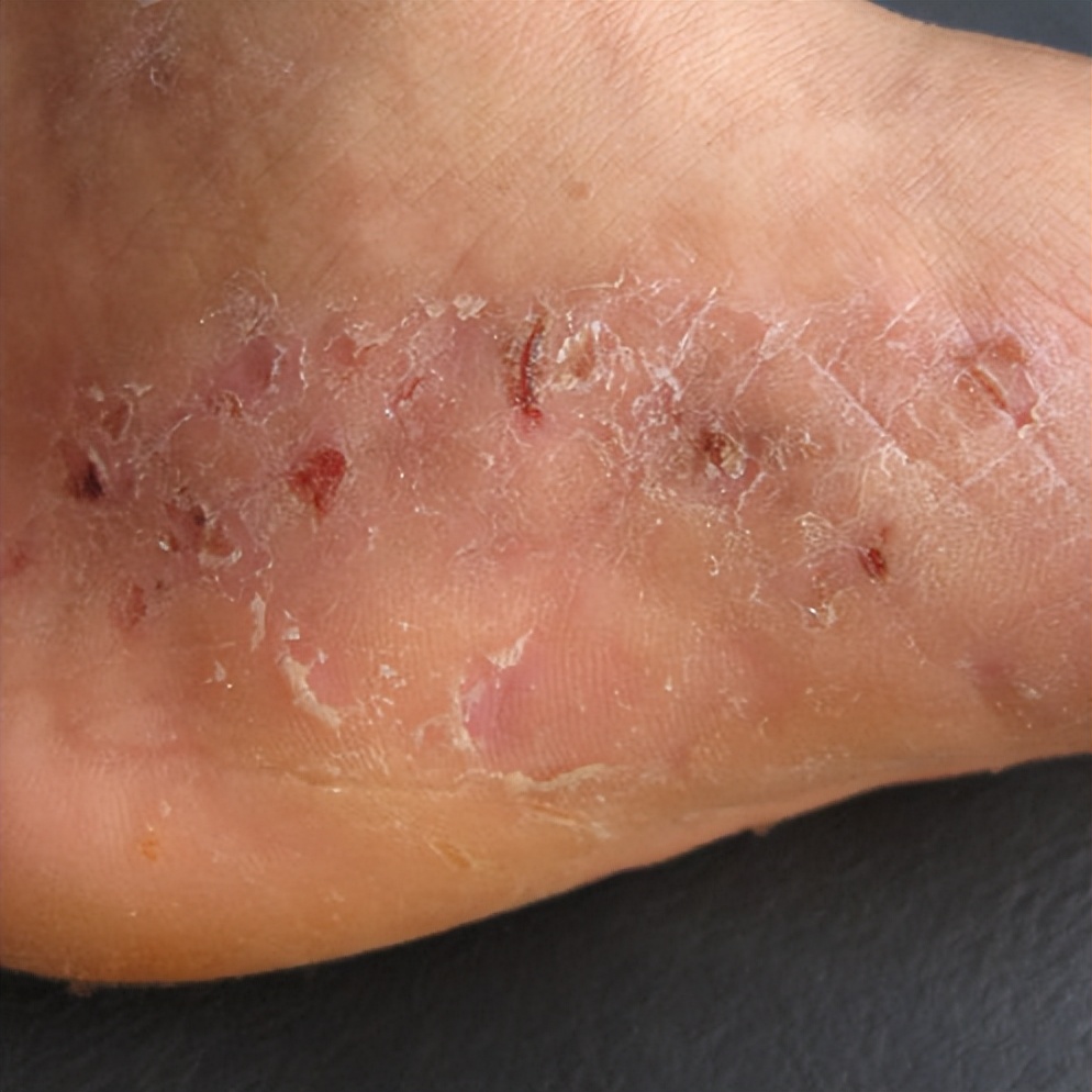 水上乐园妇科病,有妇科病能去水上乐园玩吗