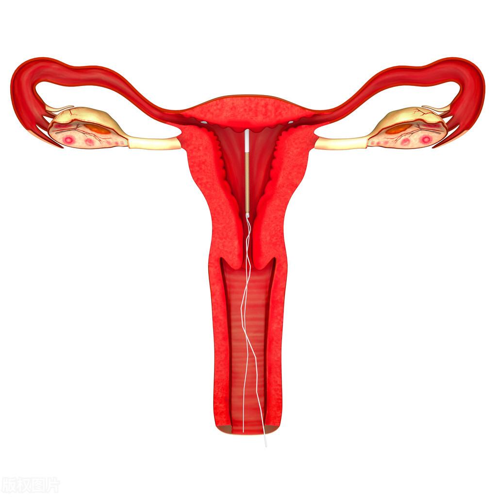 女性使用节育环，对生活会有什么影响？可能会有这5个影响