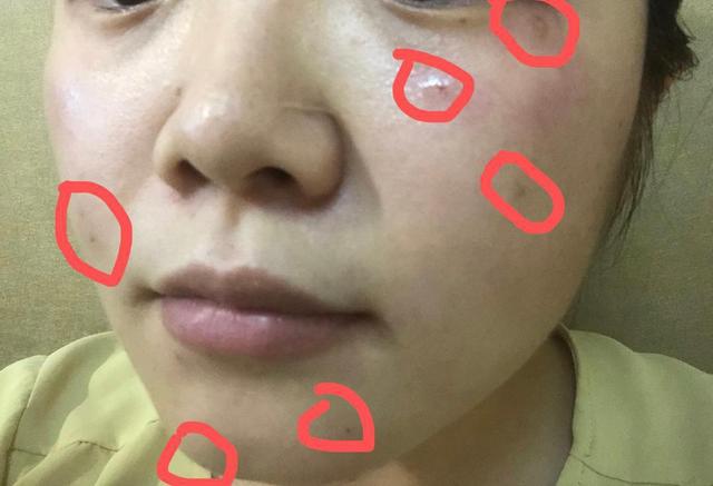 留意黑痣癌变五个重要形态,黑痣比较大才需要引起重视吗