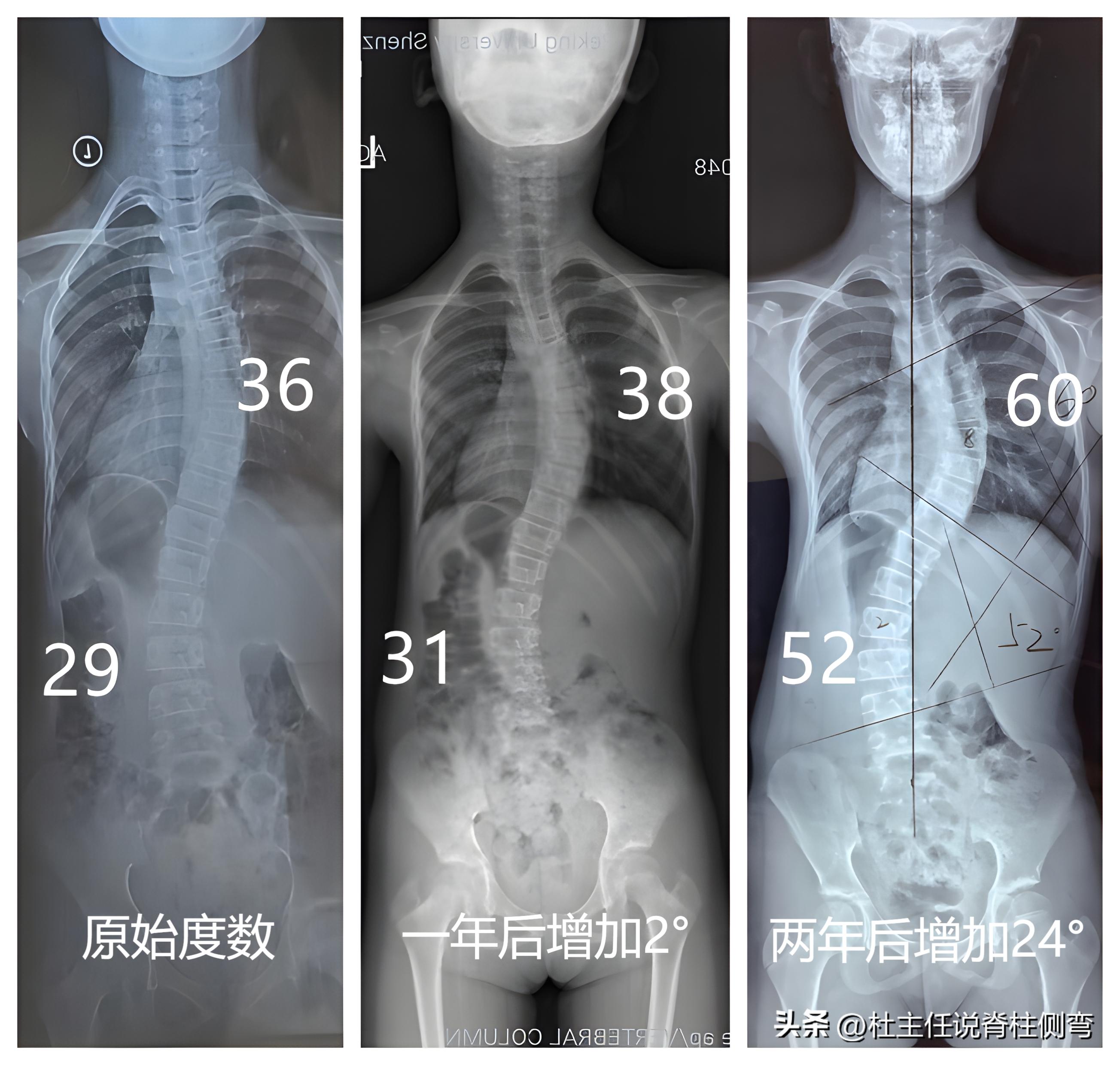 儿童侧弯10度怎么办,家长了解孩子侧弯危害性