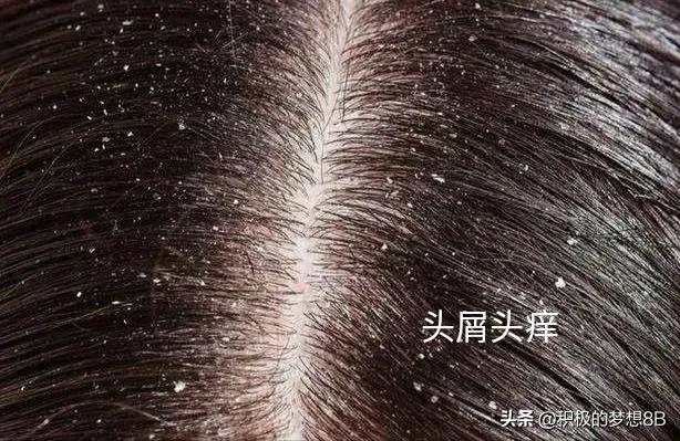头屑多皮炎怎么办,头皮脂溢性皮炎头皮屑多如何治疗
