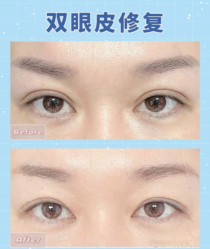 双眼皮太宽了能修复吗该怎么修复,双眼皮割窄了怎么修复宽