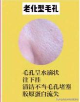 收缩毛孔粗大的方法真的有效,毛孔大怎么改善真的可以收缩毛孔