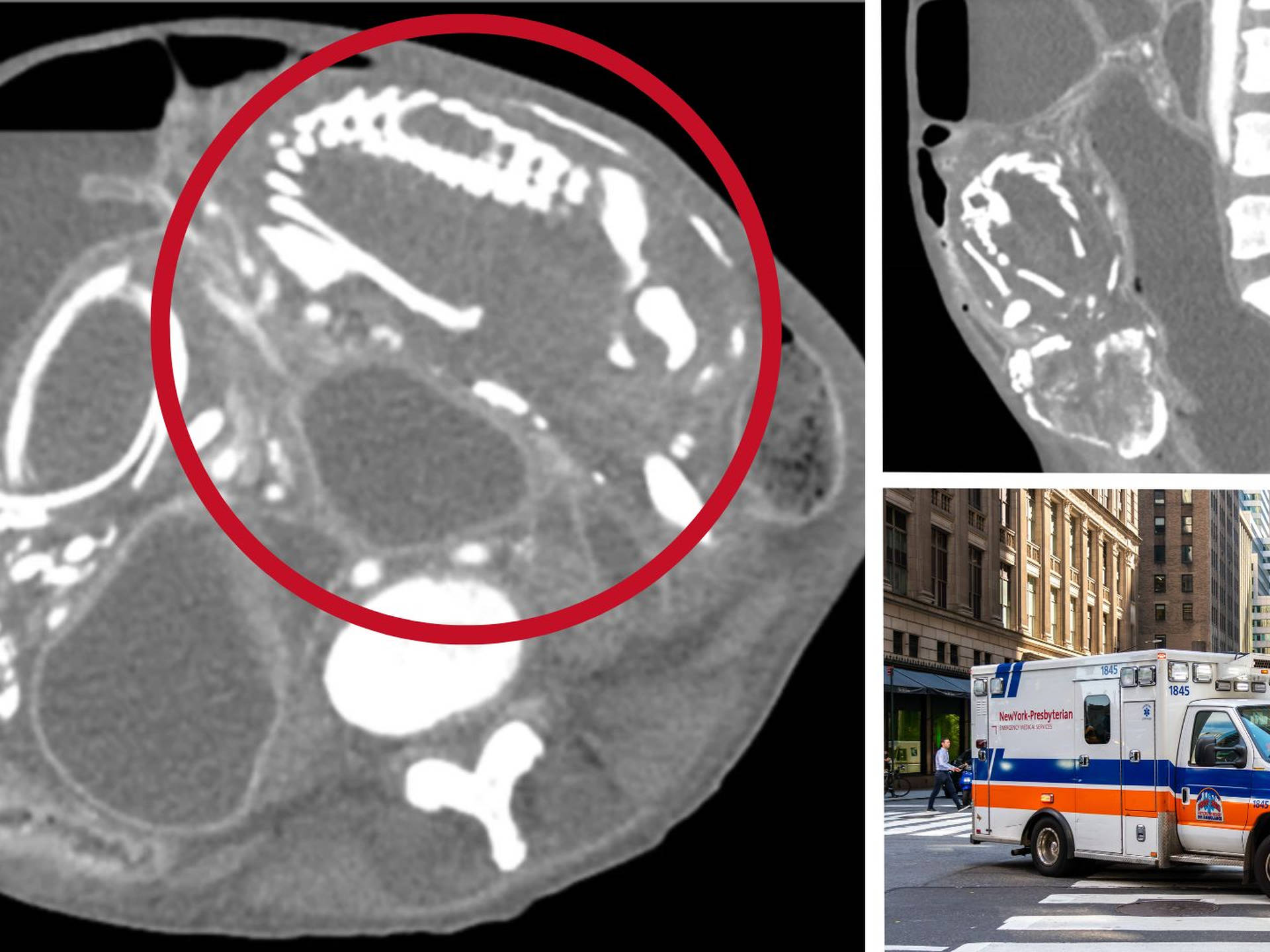 胎死腹中后孕妇有危险吗,最严重胎死腹中