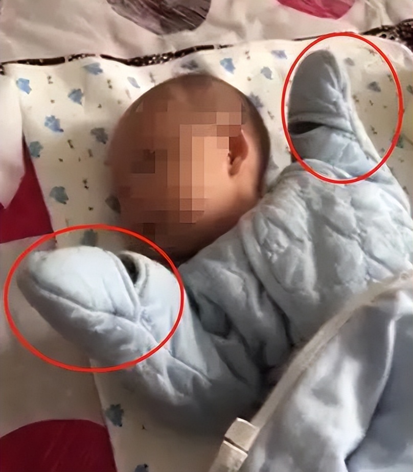 婴儿总抓破脸,婴儿老是把脸抓破怎么办