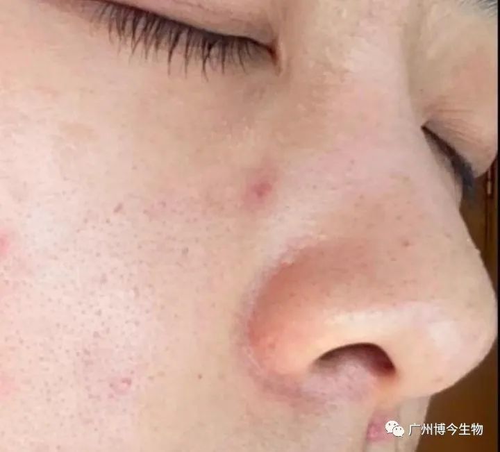 大数据请把这篇文章推给有“黑头”烦恼的人