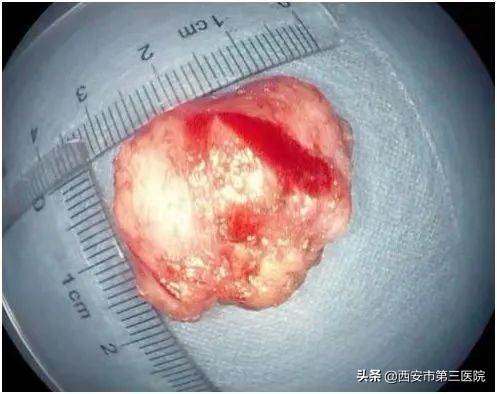 微创时代|内镜下微创直肠肿瘤切除，为您保“肛”