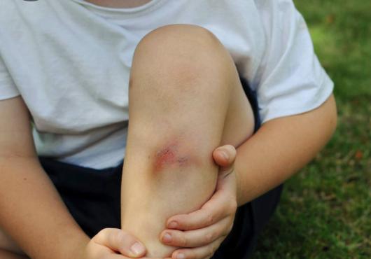 孩子磕碰怎么办,小孩子磕碰划伤擦什么药好