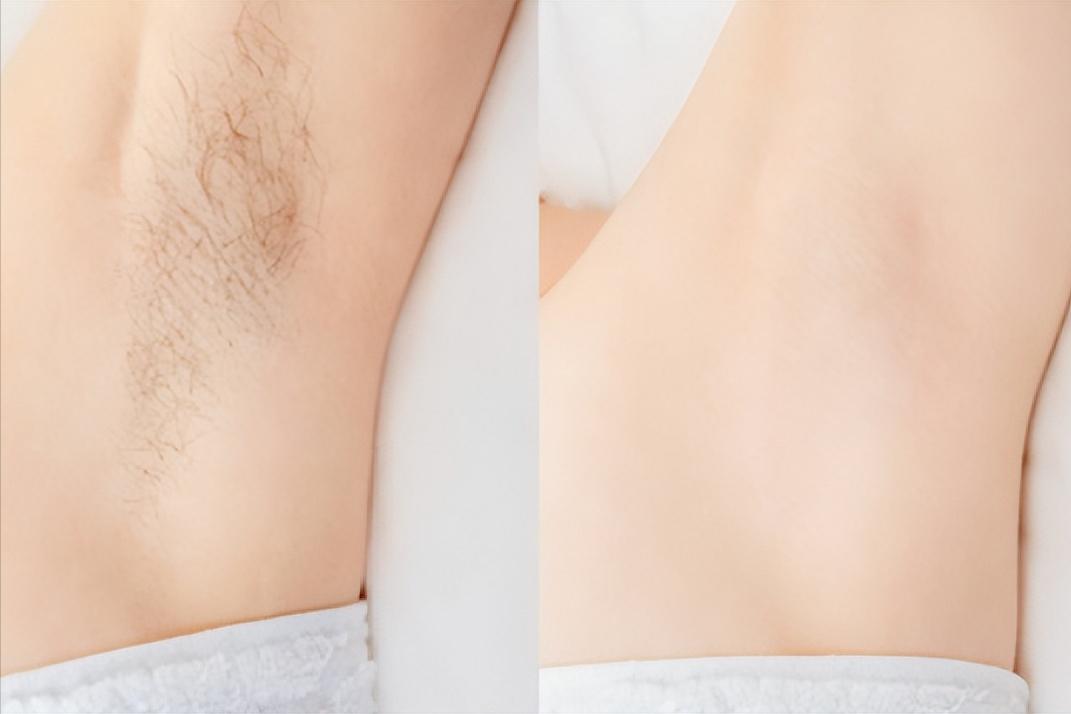 私密部位的毛，究竟能不能脱，怎么脱，这几种情况下，建议剪掉