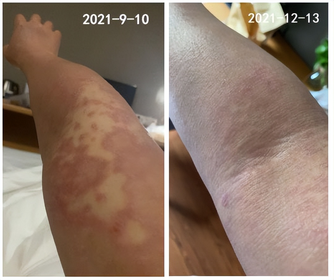 银屑病风湿性关节炎可以治愈吗,银屑病引起关节炎治疗