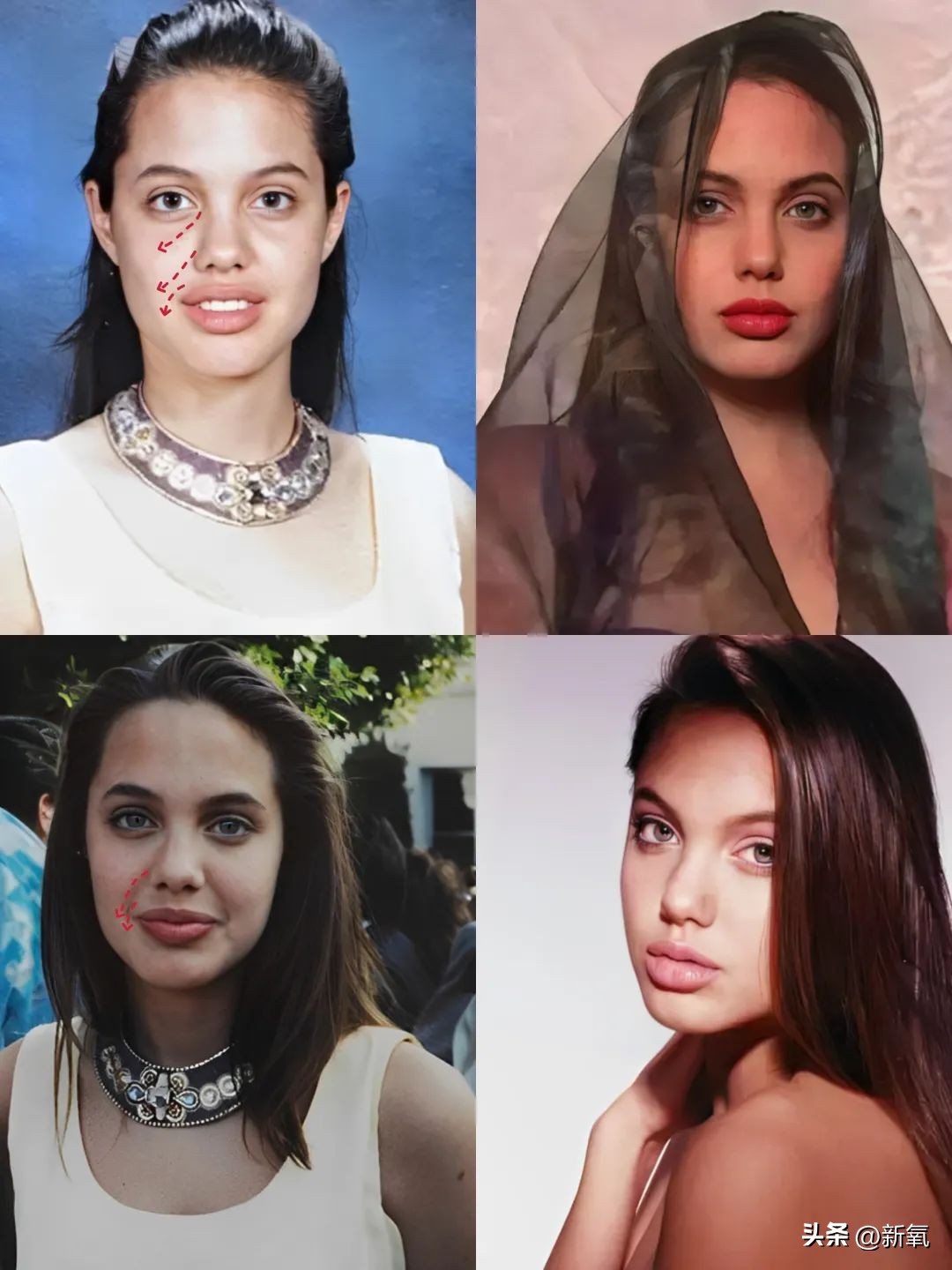 牙齿正畸和骨骼正畸的区别,牙齿正畸和眼轴增长有关系吗