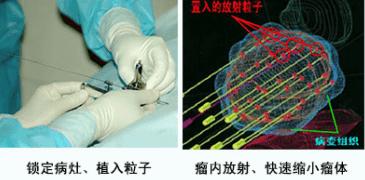肿瘤碘125粒子植入术图片,碘125粒子植入术治疗胰腺癌