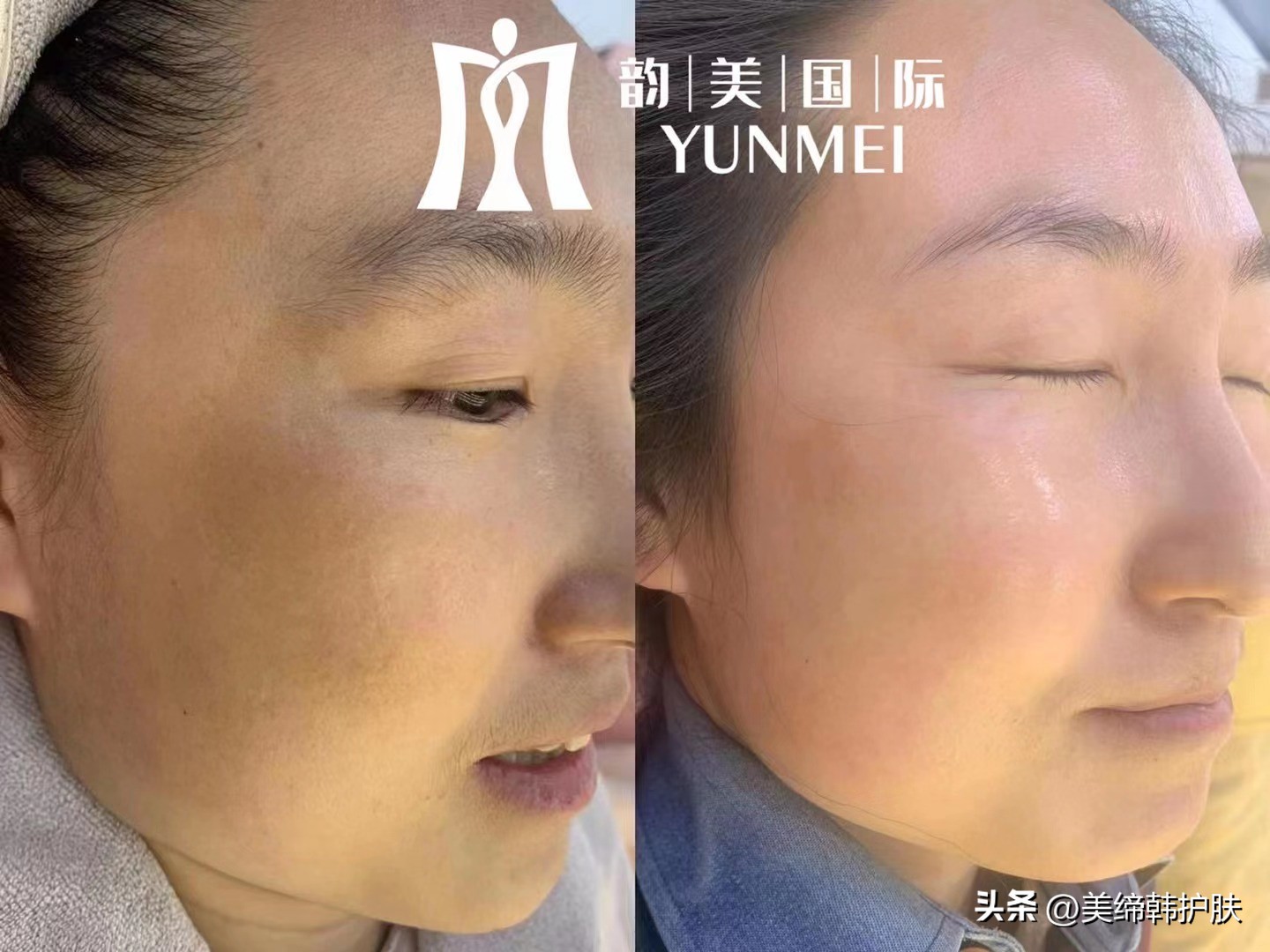 红血丝敏感肌夏天怎么护肤,敏感肌的正确护肤方法