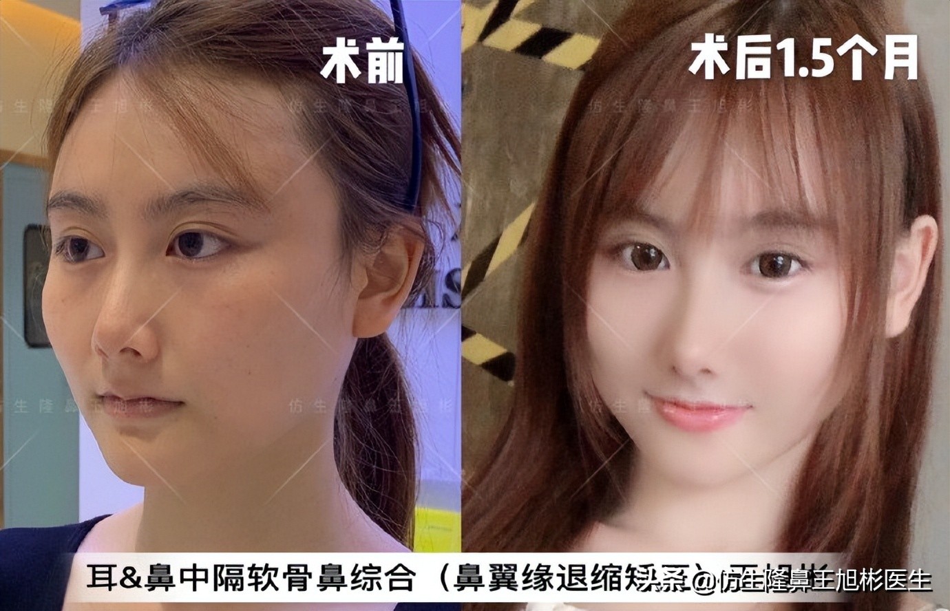 王旭彬：朝天鼻、露鼻孔，模特菲菲短鼻矫正手术后1.5个月