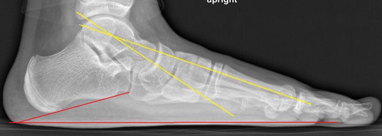 距下关节制动术成人效果如何,距下关节制动器作用