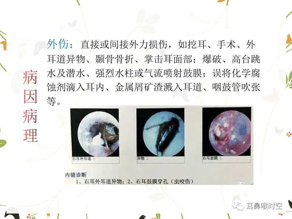 鼓膜可见穿孔,鼓膜穿孔听力下降能恢复吗