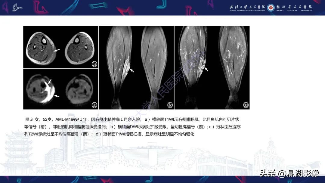 阴道肉瘤的早期症状,阴道里长肉瘤是啥症状