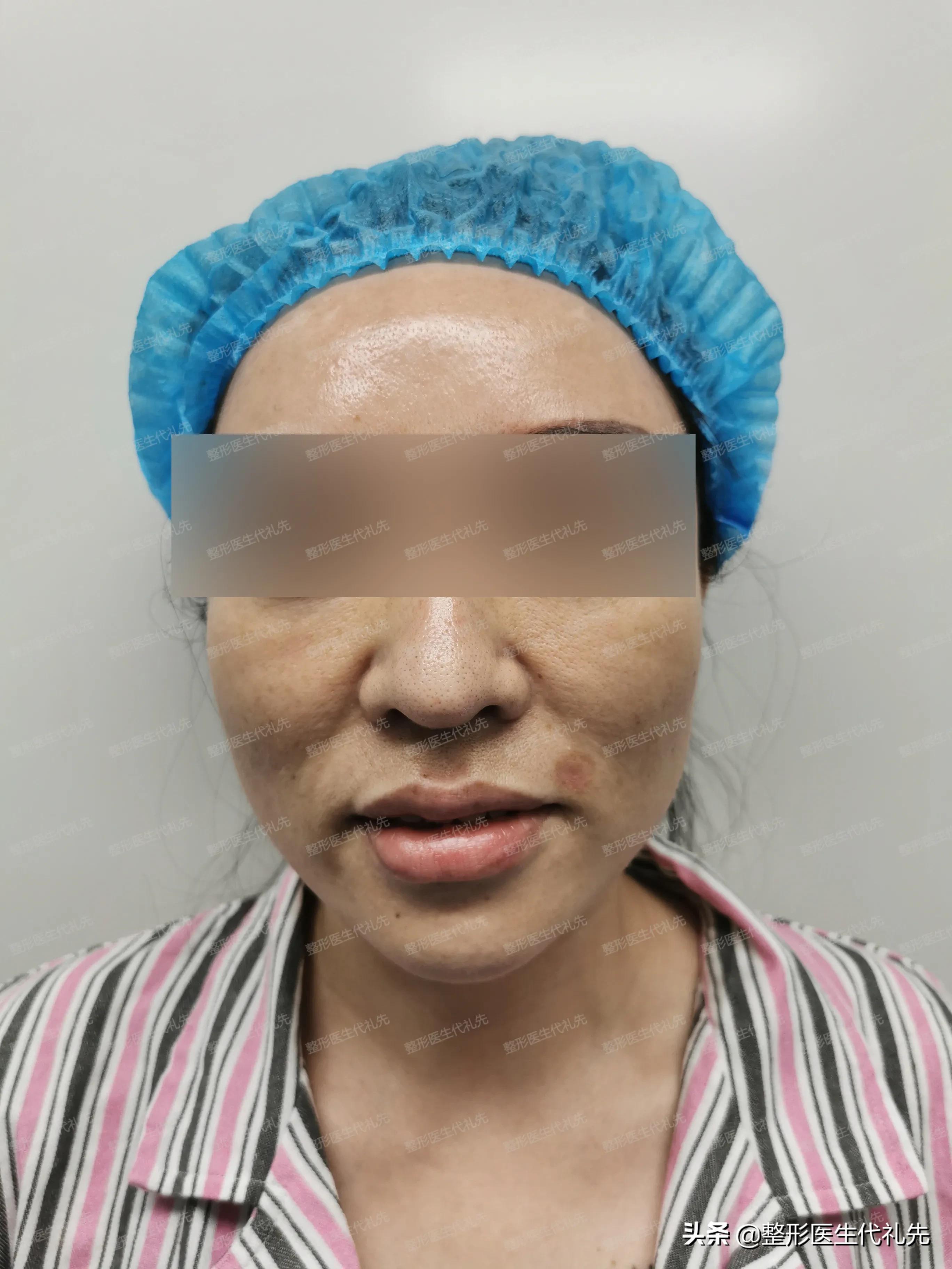 法令纹面部提升手术以后有疤痕吗,法令纹做面部提拉手术有效果吗