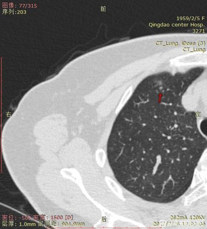3个月内磨玻璃结节,多发磨玻璃结节3个月后减少