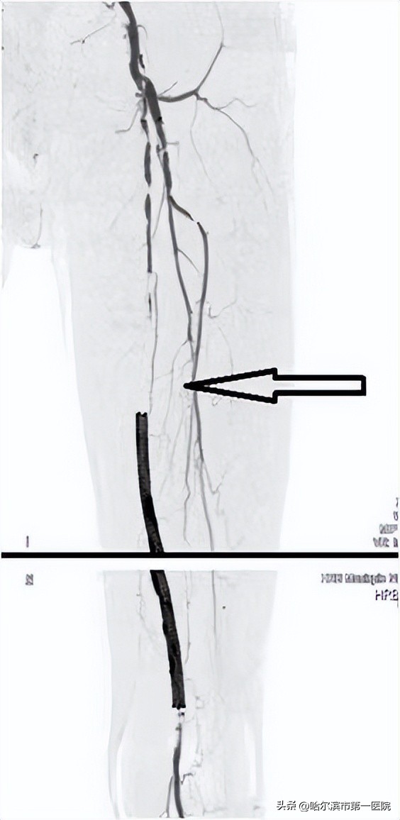 打通患者生命通道哈尔滨市第一医院血管外科应用动脉机械吸栓（Rotarex）新技术清除老人下肢动脉支架内血栓