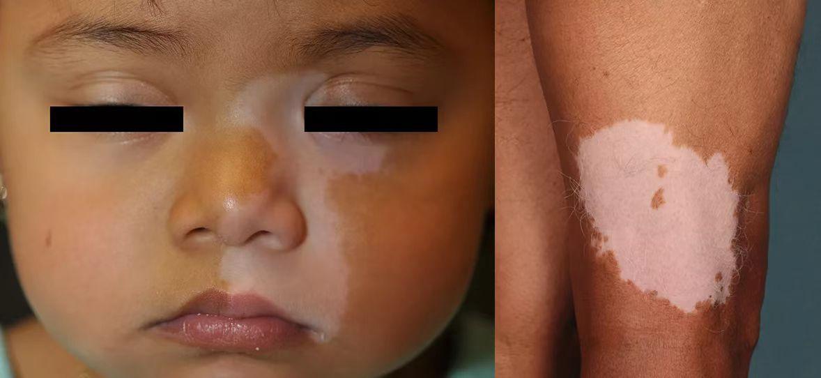 18种皮肤病白斑病,常见皮肤病斑