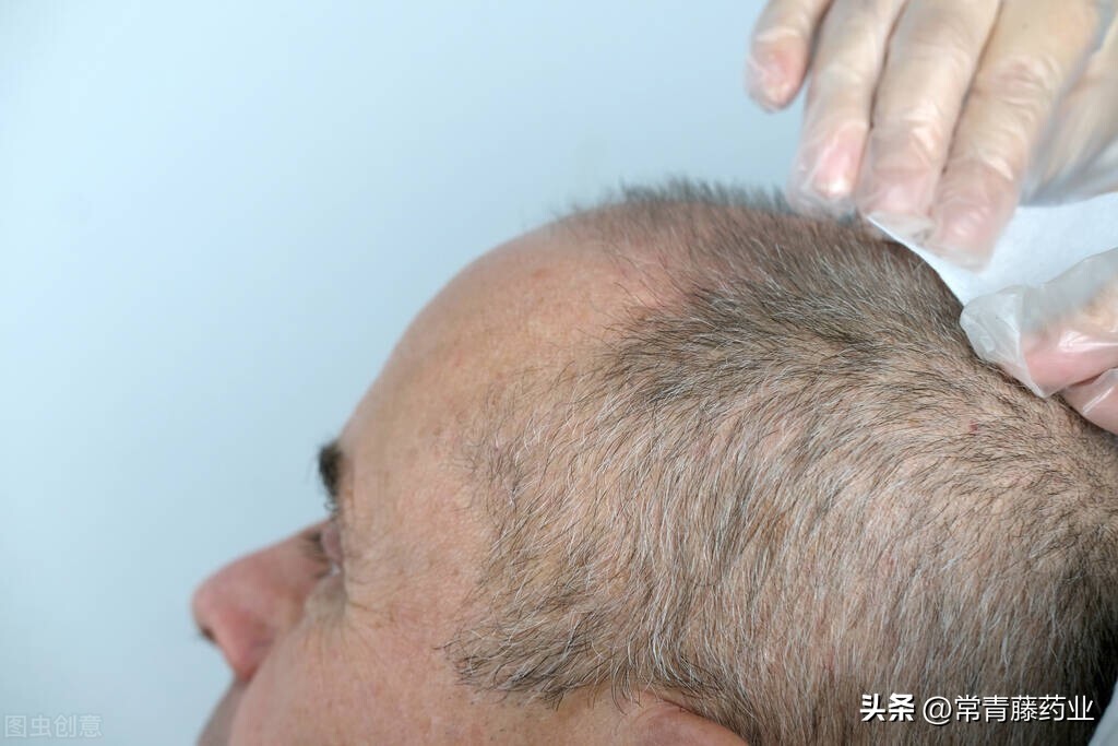 植发是唯一改善谢顶的方法吗,植发拆东墙补西