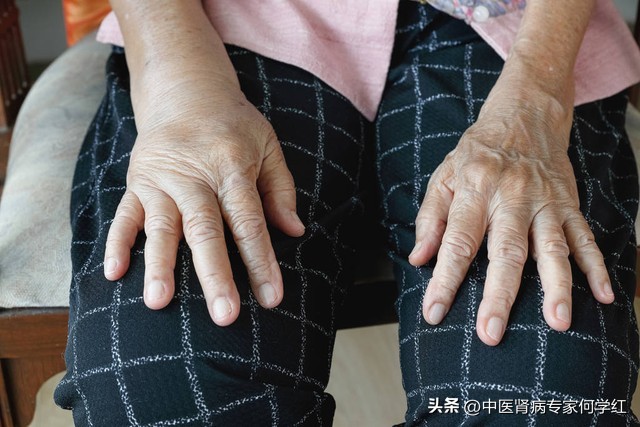 肾病综合症水肿是什么原因导致的,肾病综合症打了单抗水肿