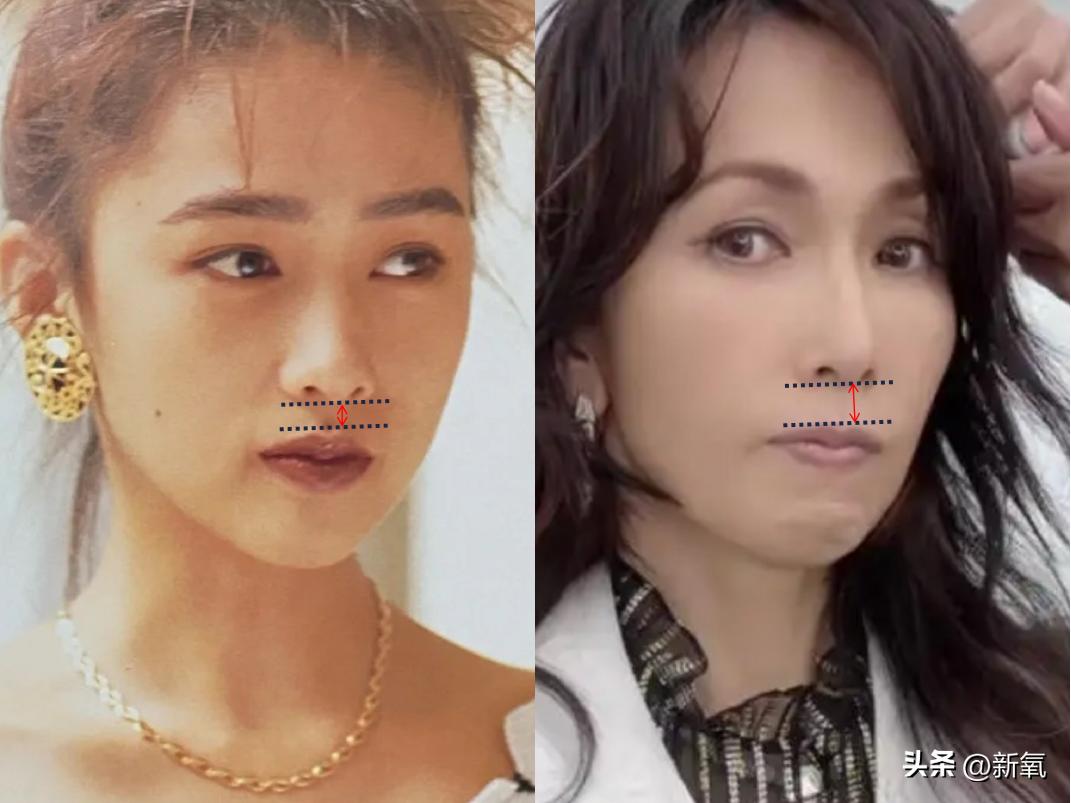 嘴唇薄变丰满,嘴唇变凸变丑怎么办