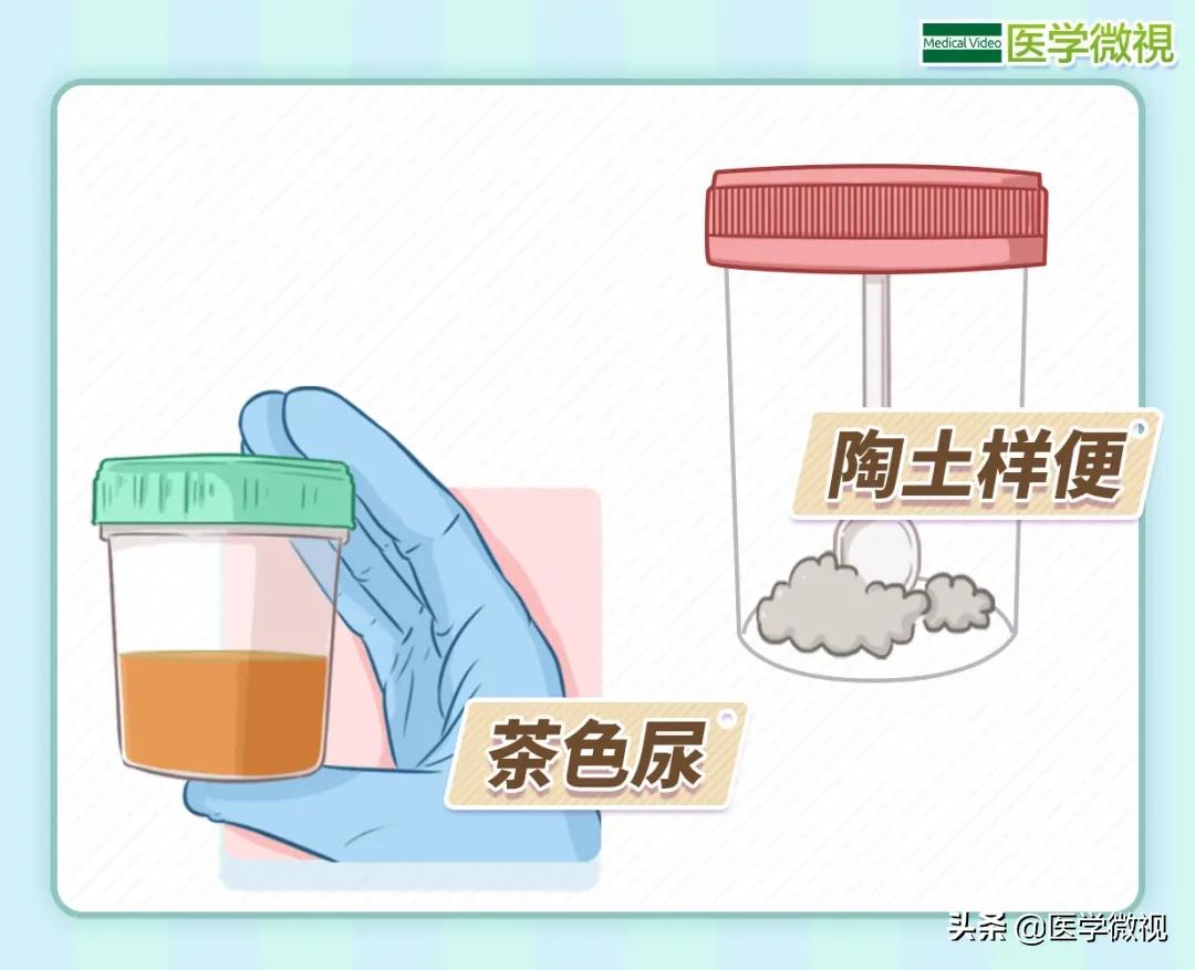 肝病的五大表现你中了几个,肝病早期九大征兆