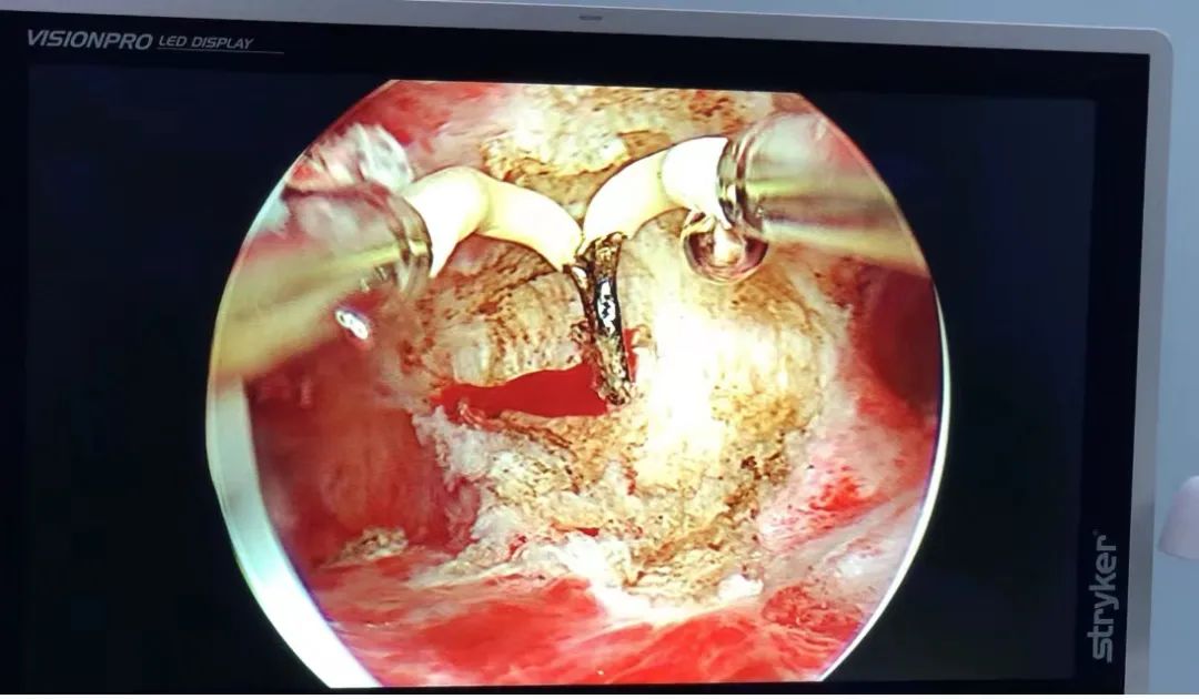 医生，B超提示我有子宫畸形，怎么办？