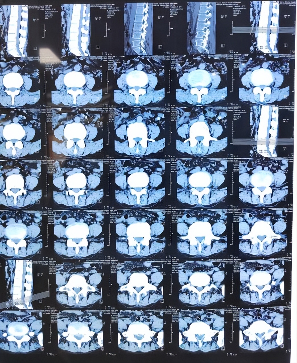 山东医专第一附属医院专栏报道㉑|小切口解决腰椎大问题！术后第二天便可下床活动