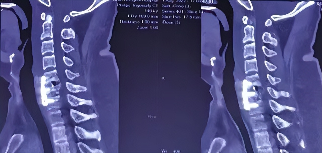 救治背部被砸伤男子,男子救人被砸中在icu抢救超24小时