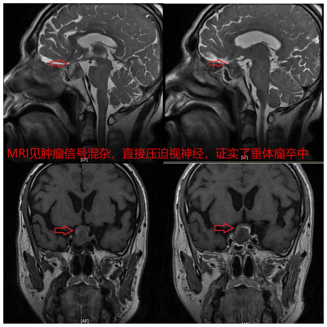 抢救失去的光明——市中心医院神经外科急症切除脑垂体瘤卒中一例