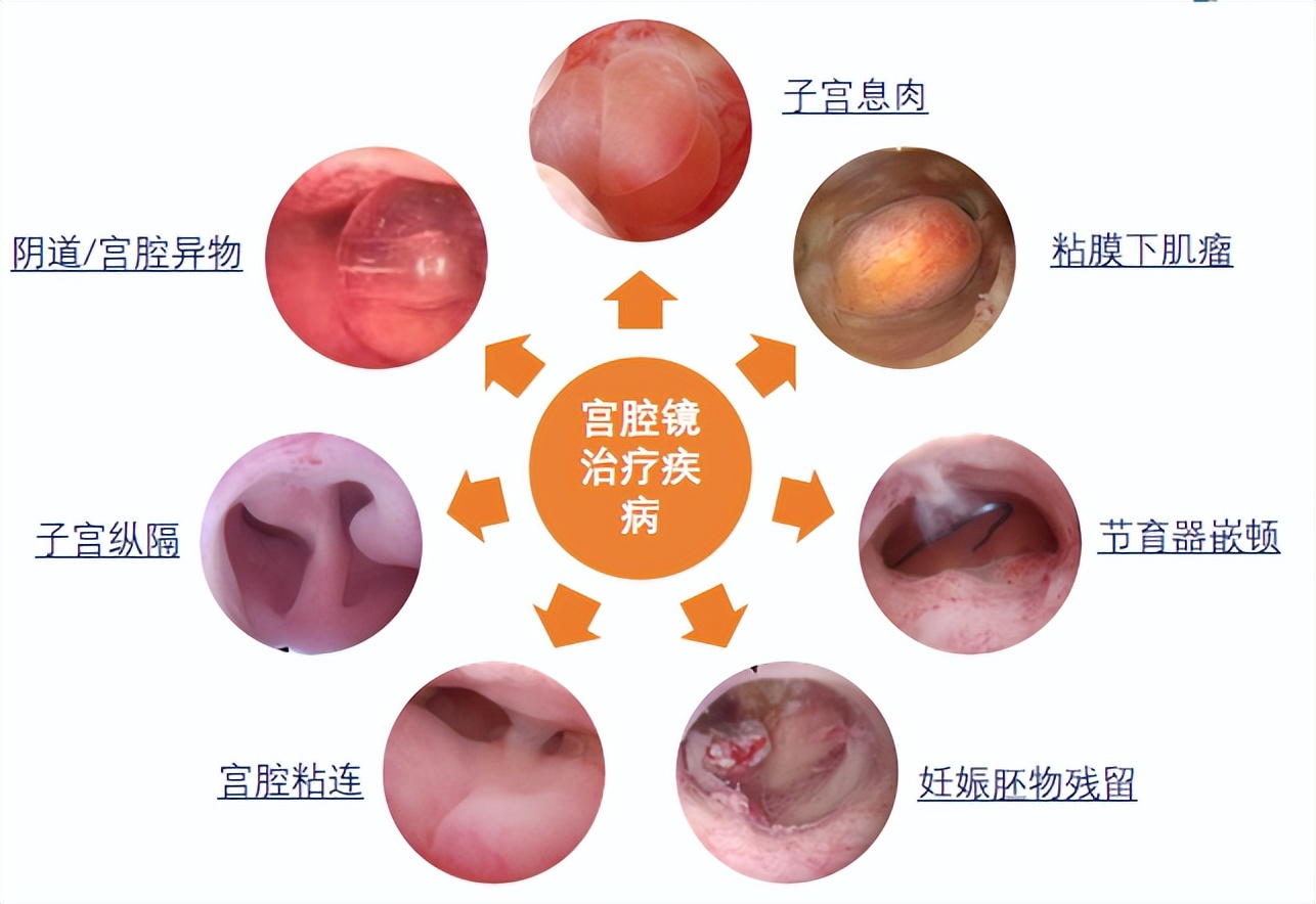 走进手术室带你了解宫腔镜,宫腔镜那些事儿
