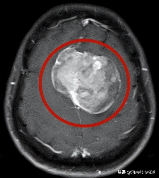 头晕头昏脑胀大脑不清是什么原因,突然头晕是大脑哪些信号