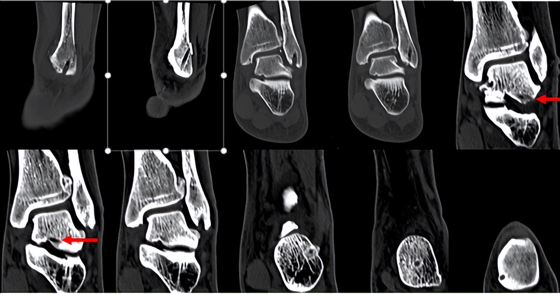 脚踝扭伤的处理方法和康复,脚踝扭伤立即进行的正确处理方法