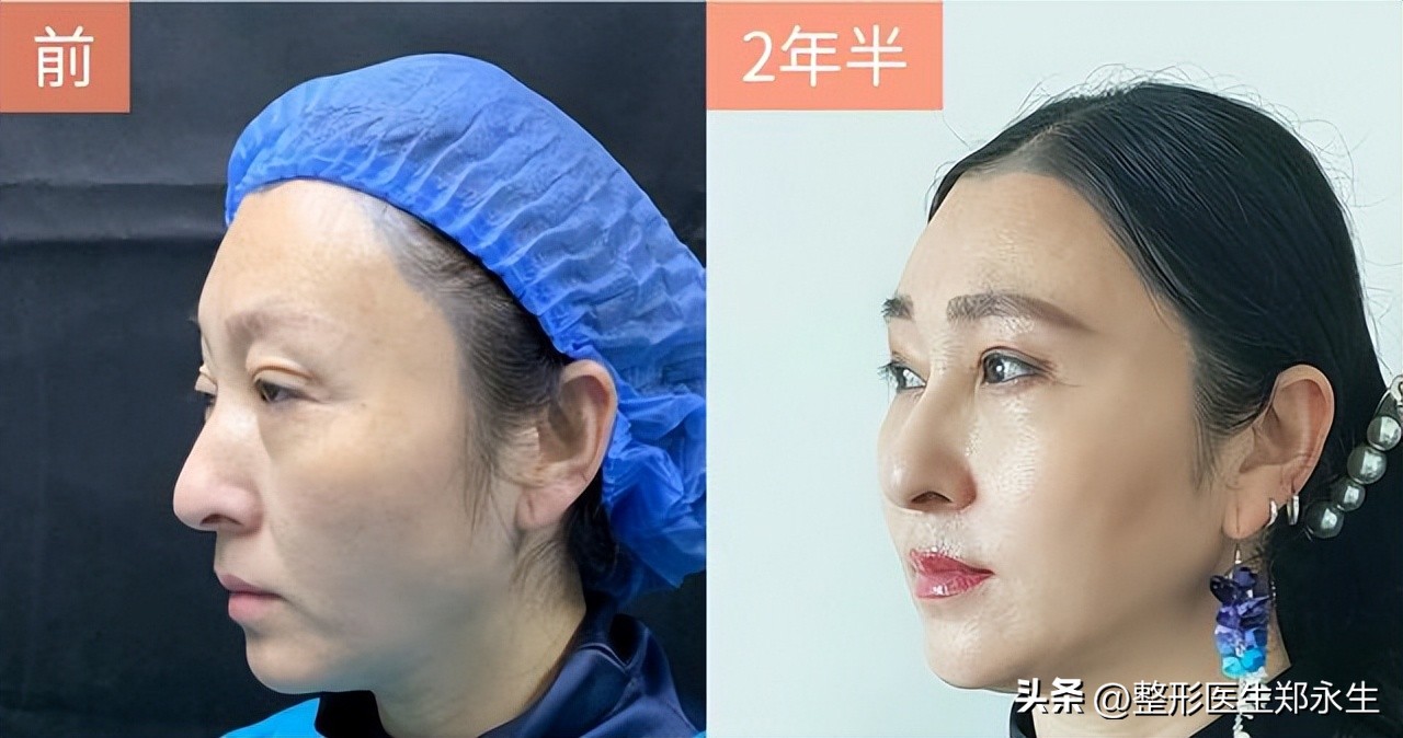 双眼皮修复手术真的很难吗,双眼皮整形真实修复过程