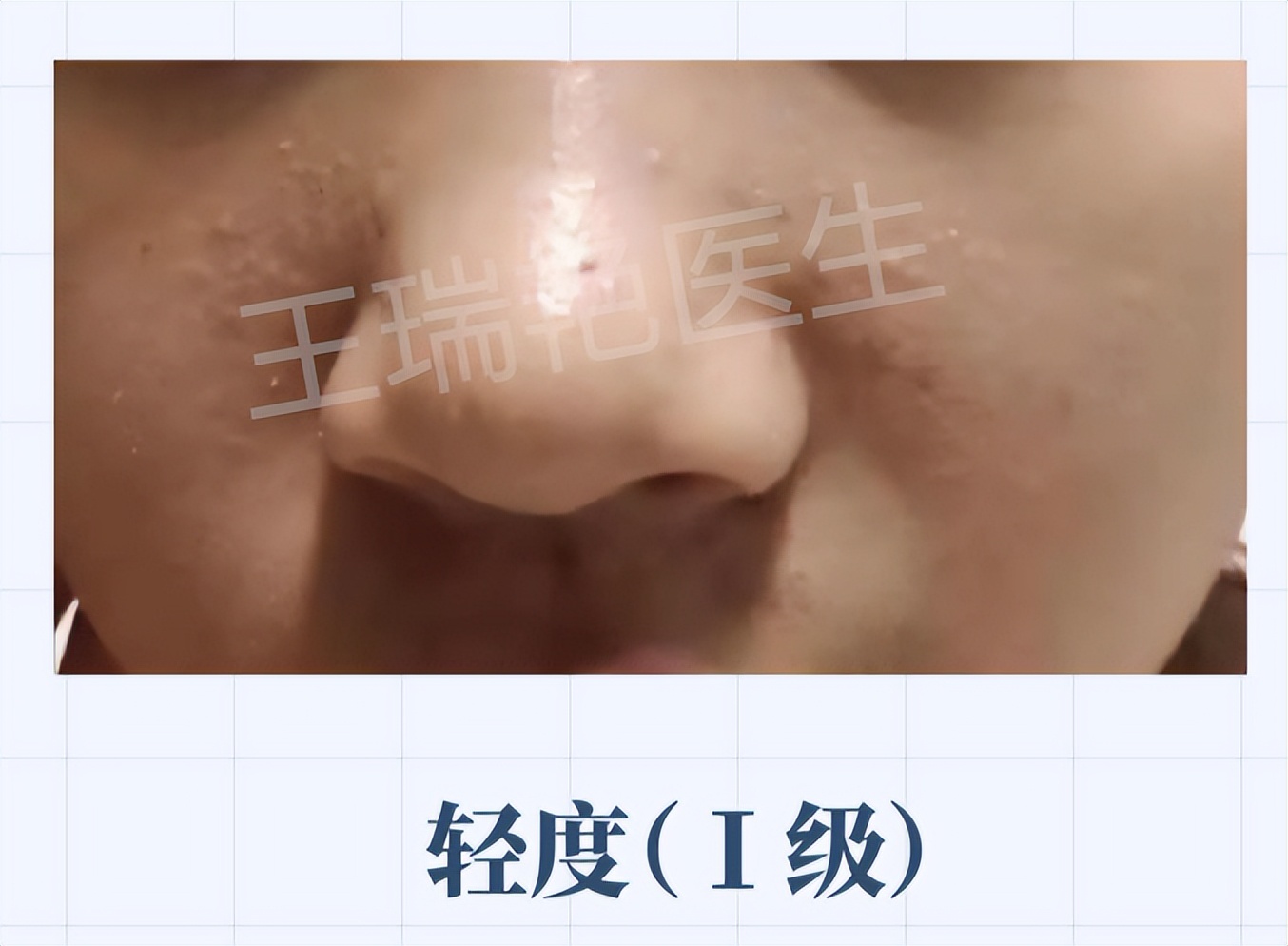 怎么区分不同种的痘痘,如何分清自己的痘痘是什么类型