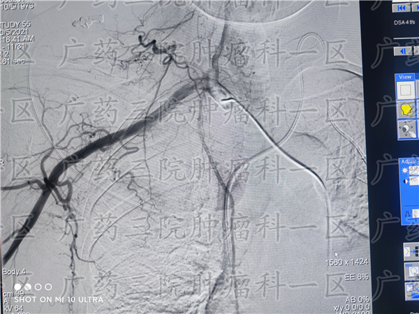 乳腺癌水肿溃烂自愈案例,乳腺癌软组织多处转移溃烂