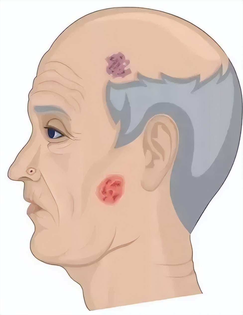 头上长了红色斑要注意了,头上有斑块怎么治