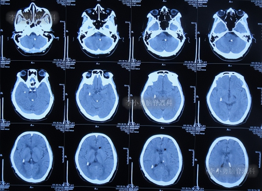 脑积水三脑室造瘘多久能恢复,脑囊虫手术后脑积水