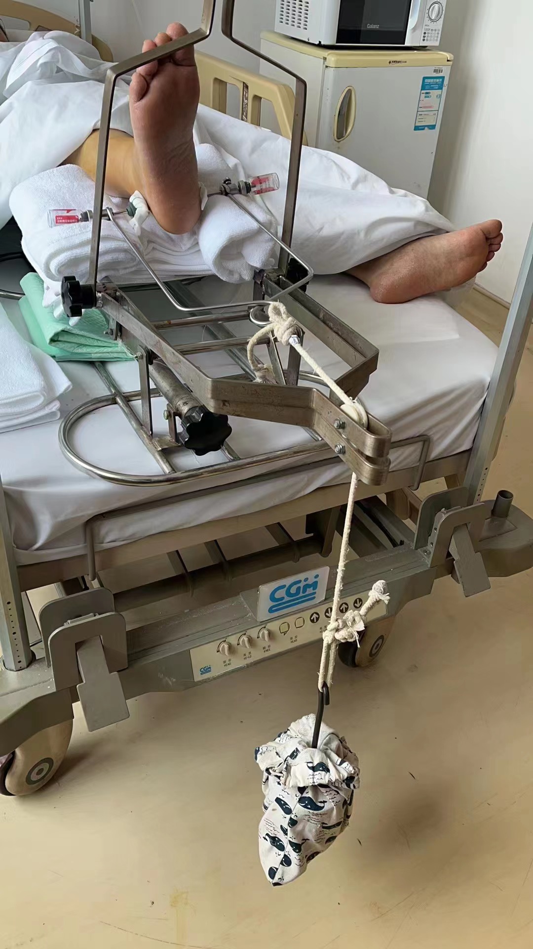 脚踝骨折手术第二十七天了,脚踝骨折手术疤痕