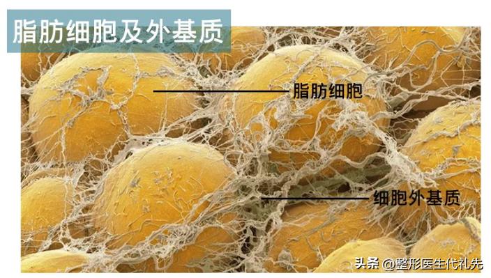 脂肪填充苹果肌刚填充的效果,填充苹果肌用什么填充